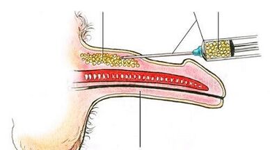 A surgical method of increasing a member