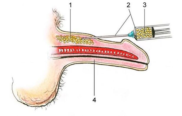 Penis enlargement with hyaluronic acid injection